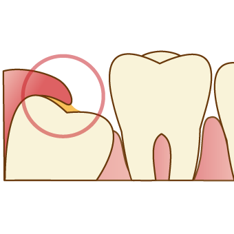 親知らずの抜歯