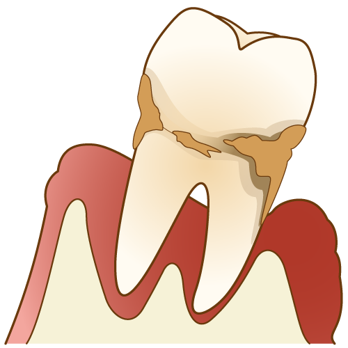 歯周病の治療